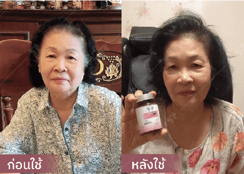 รีวิว HORSY ผมร่วง ผมบาง รอยแสกกว้าง - 2