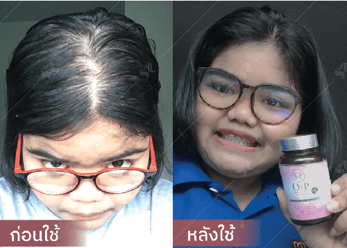 รีวิว HORSY ผมร่วง ผมบาง รอยแสกกว้าง - 1