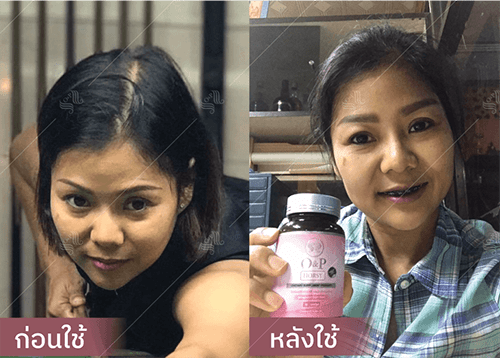 รีวิว HORSY ผมร่วง ผมบาง รอยแสกกว้าง - 9