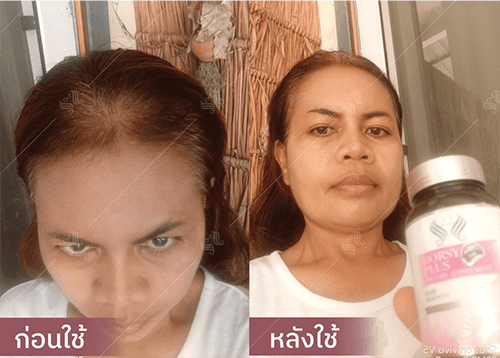 รีวิว HORSY ผมร่วง ผมบาง รอยแสกกว้าง - 8