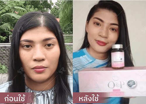 รีวิว HORSY ผมร่วง ผมบาง รอยแสกกว้าง - 2