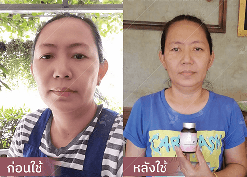 รีวิว HORSY ผมร่วง ผมบาง รอยแสกกว้าง - 12