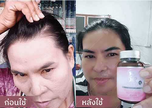 รีวิว HORSY ผมร่วง ผมบาง รอยแสกกว้าง - 3
