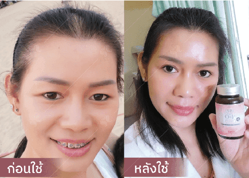 รีวิว HORSY ผมร่วง ผมบาง รอยแสกกว้าง - 3