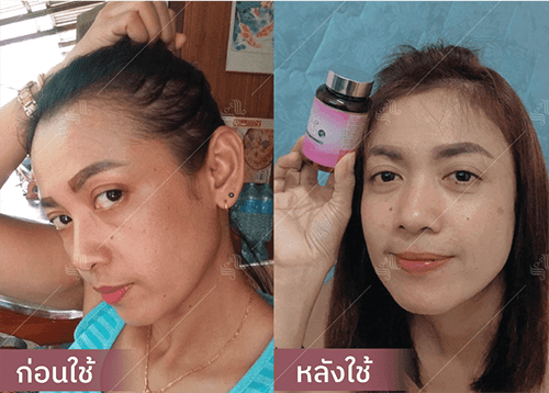 รีวิว HORSY ผมร่วง ผมบาง รอยแสกกว้าง - 5