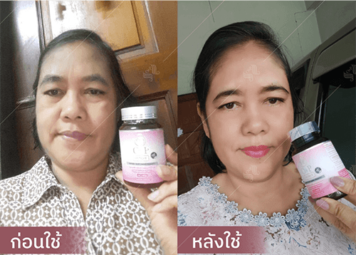 รีวิว HORSY ผมร่วง ผมบาง รอยแสกกว้าง - 6