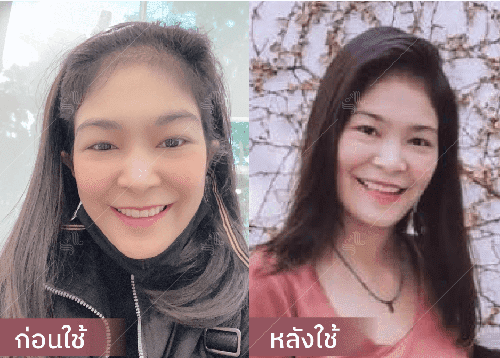 รีวิว HORSY ผมร่วง ผมบาง รอยแสกกว้าง - 4