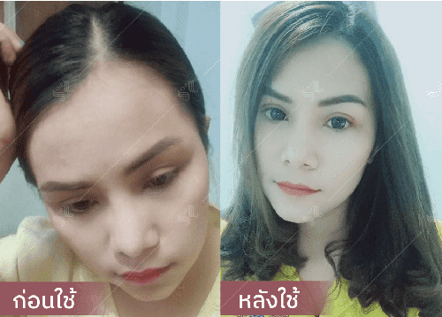 รีวิว HORSY ผมร่วง ผมบาง รอยแสกกว้าง - 12