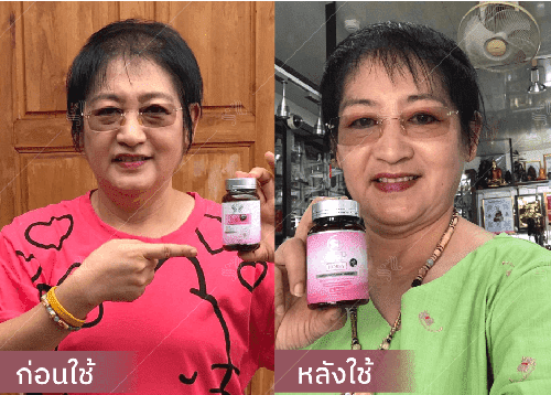 รีวิว HORSY ผมร่วง ผมบาง รอยแสกกว้าง - 5