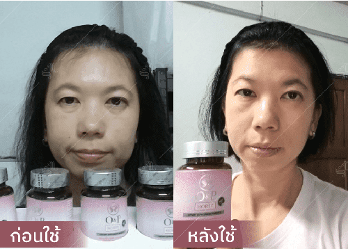 รีวิว HORSY ผมร่วง ผมบาง รอยแสกกว้าง - 9