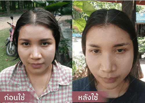 รีวิว HORSY ผมร่วง ผมบาง รอยแสกกว้าง - 10