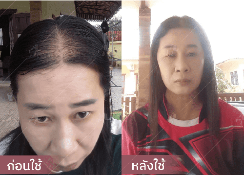 รีวิว HORSY ผมร่วง ผมบาง รอยแสกกว้าง - 5