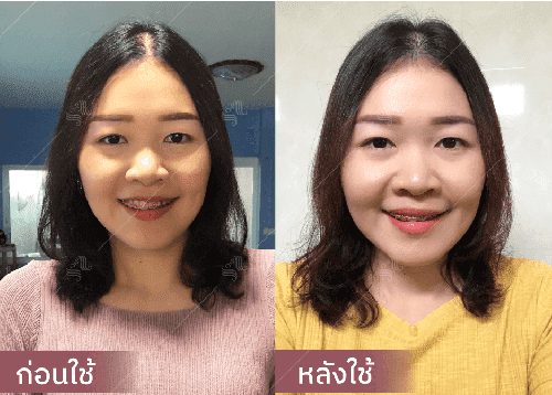 รีวิว HORSY ผมร่วง ผมบาง รอยแสกกว้าง - 6