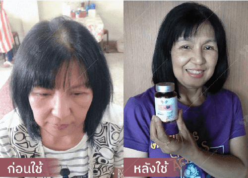 รีวิว HORSY ผมร่วง ผมบาง รอยแสกกว้าง - 11