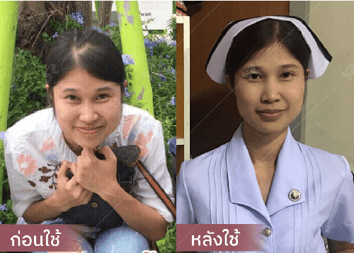 รีวิว HORSY ผมร่วง ผมบาง รอยแสกกว้าง - 4