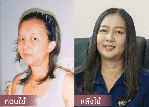 รีวิว HORSY ผมร่วง ผมบาง รอยแสกกว้าง - 10