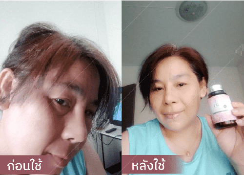 รีวิว HORSY ผมร่วง ผมบาง รอยแสกกว้าง - 6