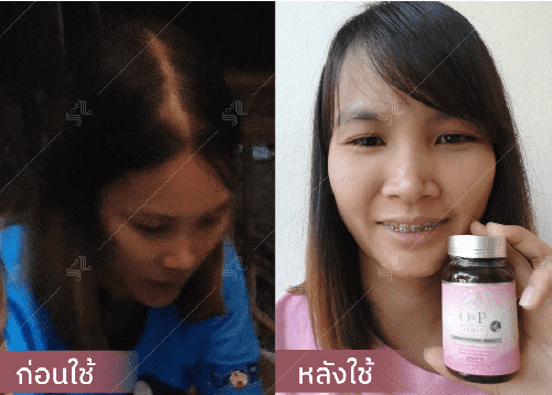 รีวิว HORSY ผมร่วง ผมบาง รอยแสกกว้าง - 7