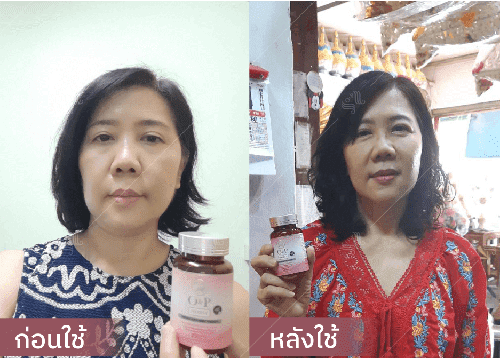 รีวิว HORSY ผมร่วง ผมบาง รอยแสกกว้าง - 2