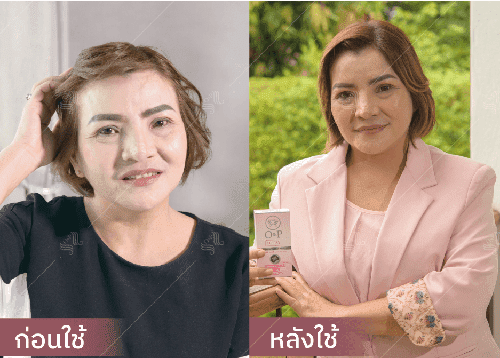 รีวิว HORSY ผมร่วง ผมบาง รอยแสกกว้าง - 1