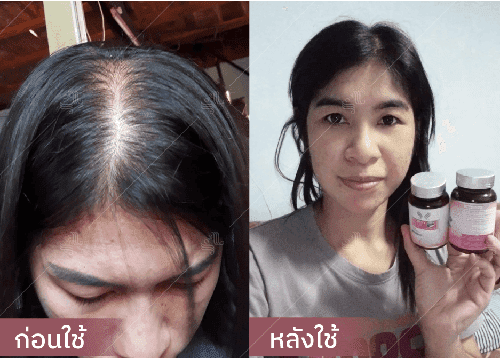 รีวิว HORSY ผมร่วง ผมบาง รอยแสกกว้าง - 3