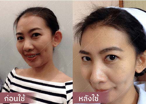 horsy_before-after016