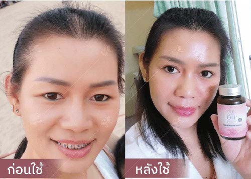 horsy_before-after020